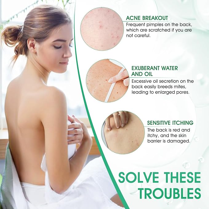 Spray Antiacné Corporal – Limpieza Profunda y Cuidado de la Piel