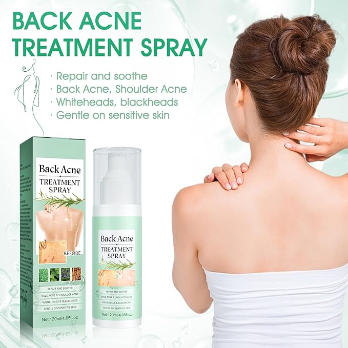 Spray Antiacné Corporal – Limpieza Profunda y Cuidado de la Piel